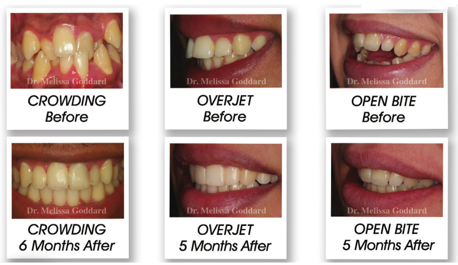Fastbraces Orthdontics Melissa Goddard Amazing Quick Results